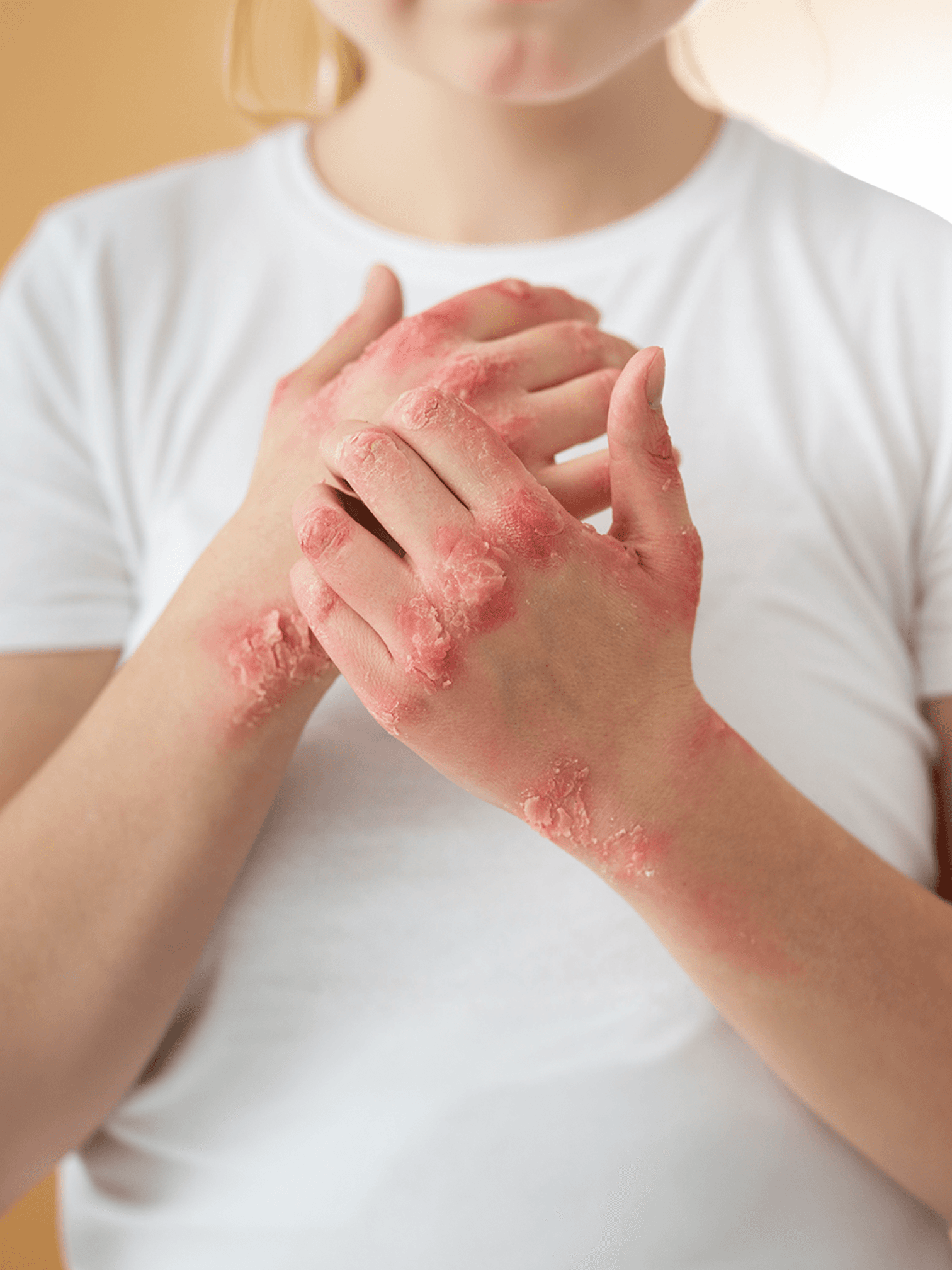 Deri Bariyer + Mikrobiyota Terkibi A / Egzama–Ürtiker–Liken–Akne–Zona–Çıban Eğiliminde Tedaviye Destek